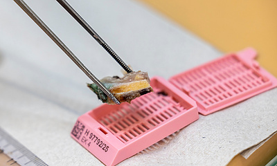 Gewebeprobe wird auf der Pathologie analysiert
