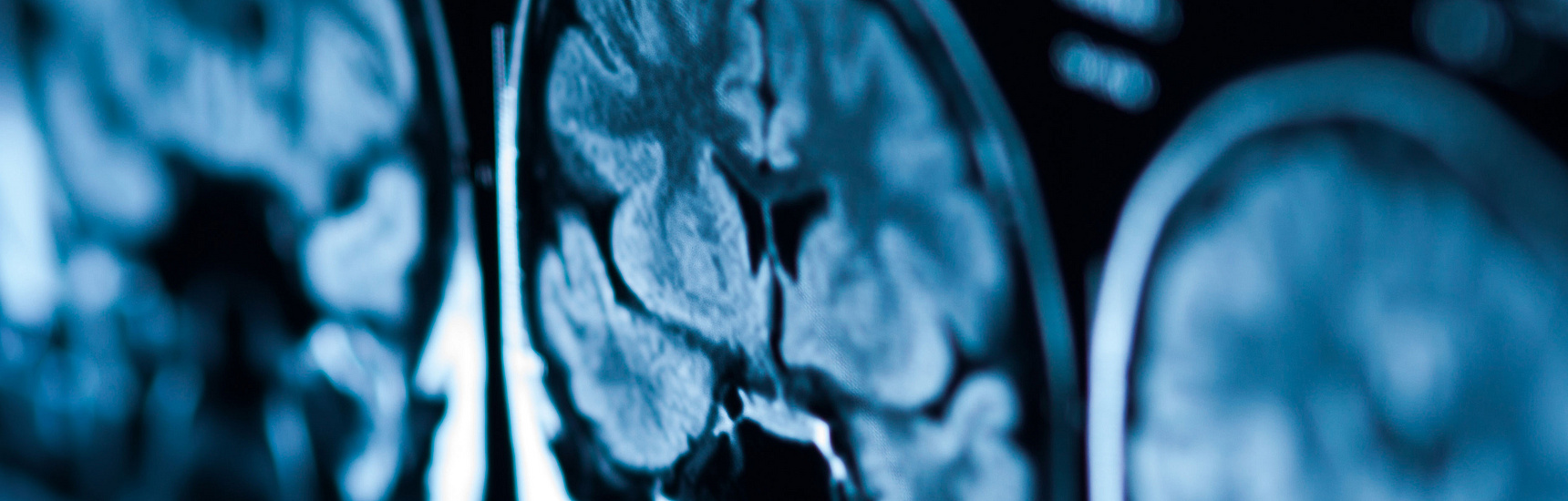 Tomography pictures of the brain