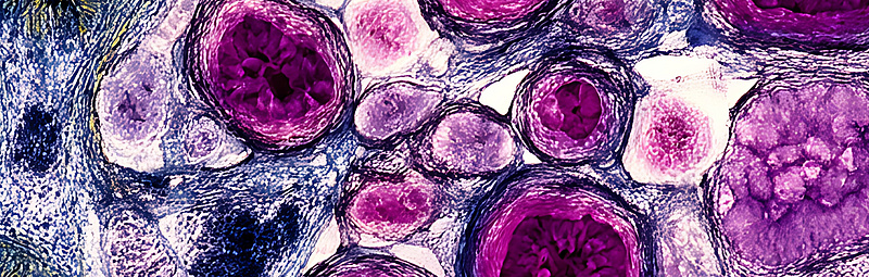 Krebszellen unter einem Mikroskop