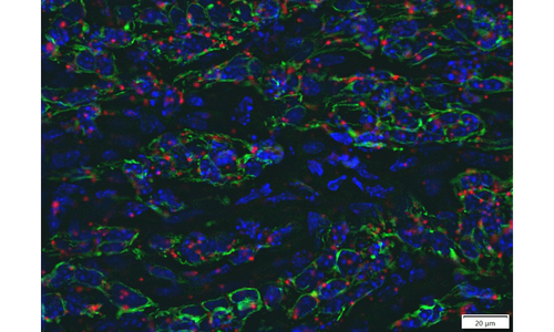 In situ hybridization (MGL; red) combined with immunofluorescence cytokeratin (green) in tumors of mouse allografts.
