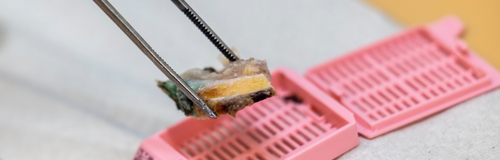 Gewebeprobe wird auf der Pathologie analysiert