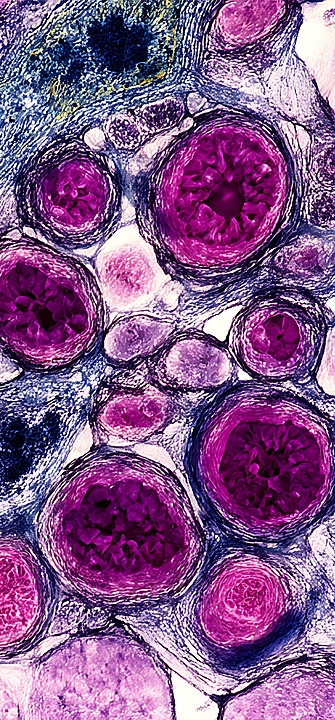 Licht aktiviert Chemotherapie gezielt am Tumor Licht aktiviert Chemotherapie gezielt am Tumor