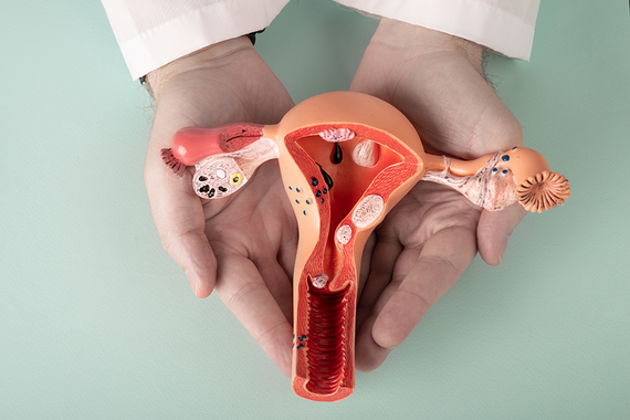 Endometriose