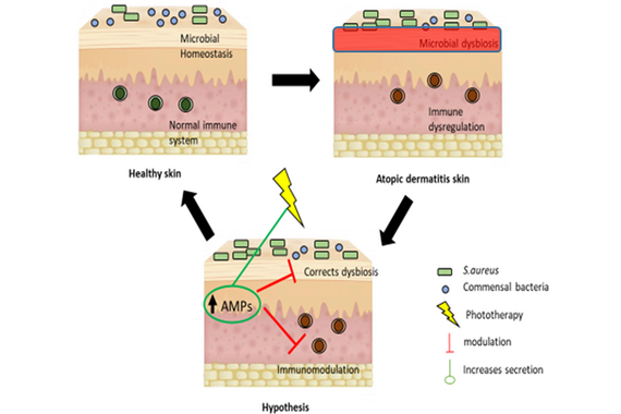 Therapeutic potential of antimicrobial peptides in atopic dermatitis