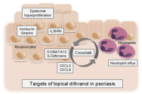 Dithranol in psoriasis and beyond