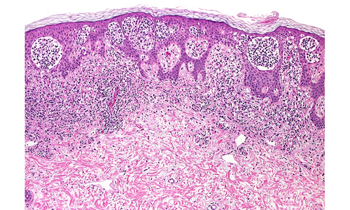 Mykosis fungoides: Bandförmige lymphoidzellige Infiltrate mit mehreren intraepidermalen "Pautriersche Mikroabszessen".